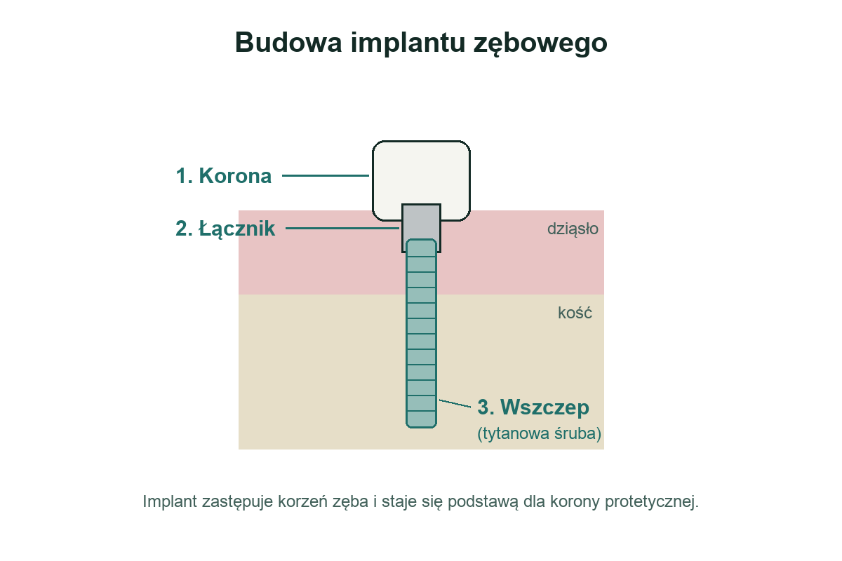 Schemat budowy implantu zębowego: korona, łącznik i wszczep w kości
